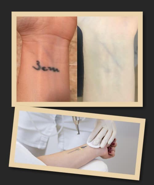 лазерне видалення татуювань