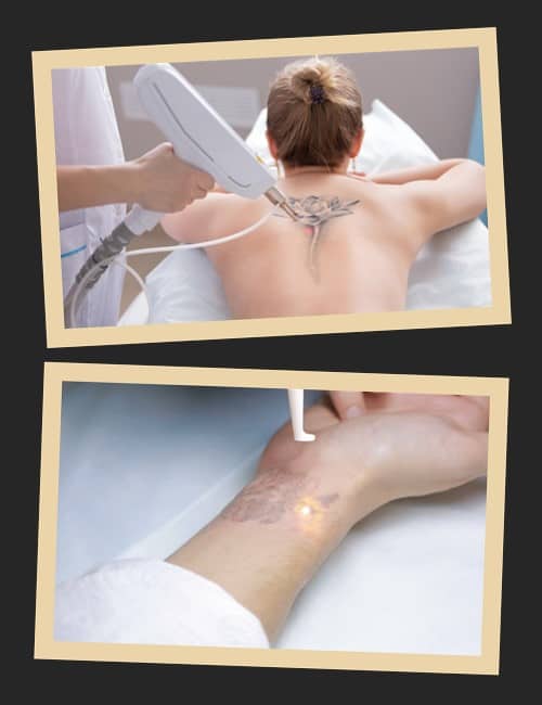 противопоказания к процедуре выведения тату