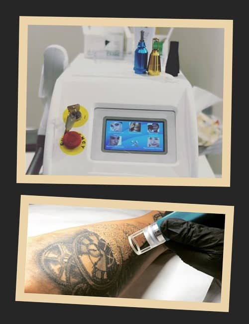 Чому найкращим вважається лазерний метод?