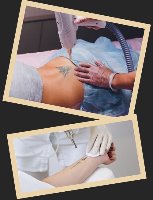 протиповказання до видалення тату