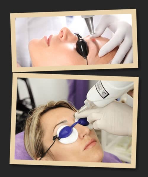 переваги застосування лазера для видалення татуажу