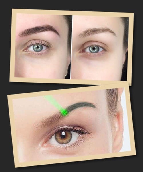 перевагою лазерного виведення татуажу