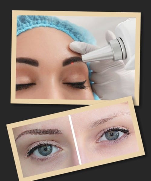 видаляти татуаж брів за допомогою лазера