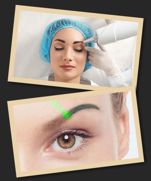 найбезпечніший метод виведення перманентного макіяжу – лазерний