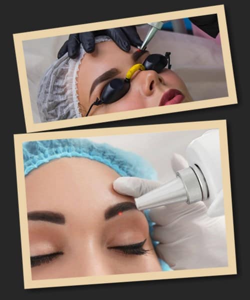 лазерний метод виведення перманентного макіяжу