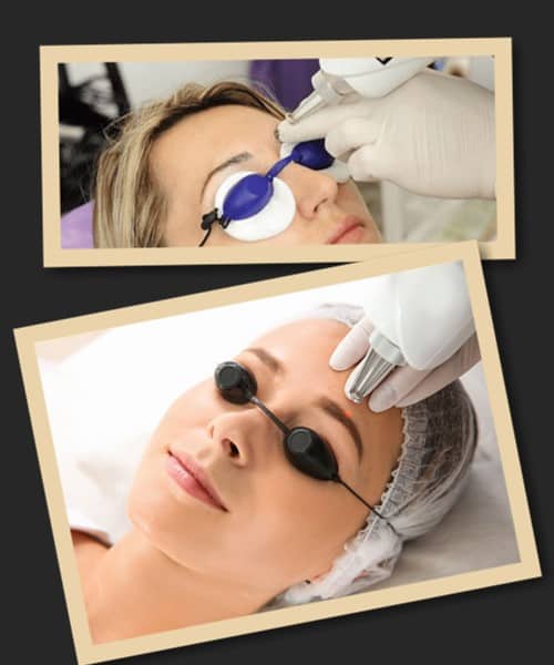 Етапи лазерного видалення татуажу