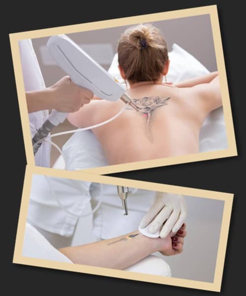 Рicosure лазер для видалення татуювань