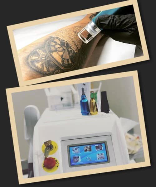 Чим відрізняються лазери для видалення татуювань