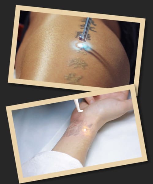 виведення татуювання лазером