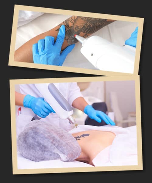 Як відбувається видалення пігменту тату