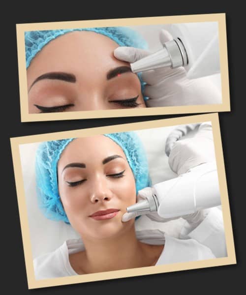 Які переваги має видалення перманенту лазером