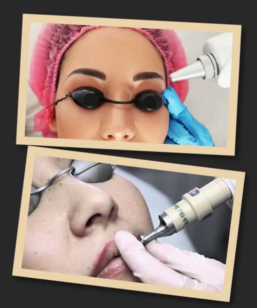 Лазерний апарат можна використовувати для видалення татуажу