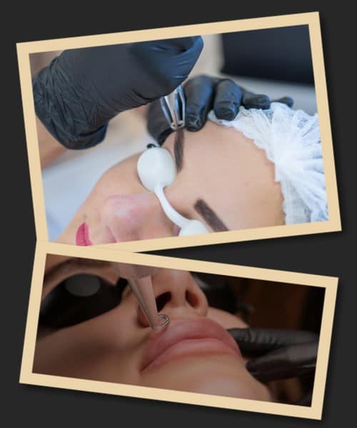 ефект від лазерного впливу НА ТАТУАЖ