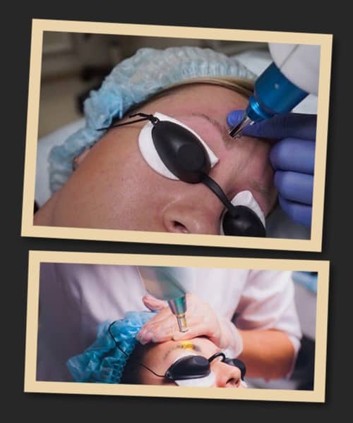 Лазерне видалення татуажу брів