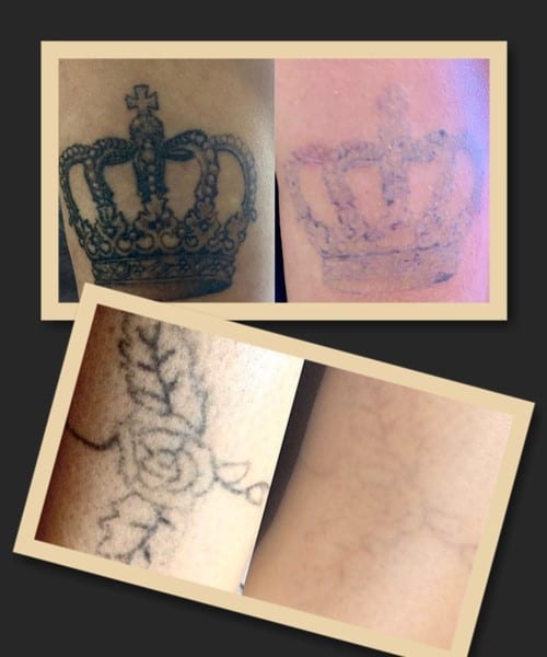 Як видалити тату ремувером