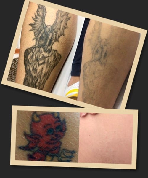 Особливості ремуверу