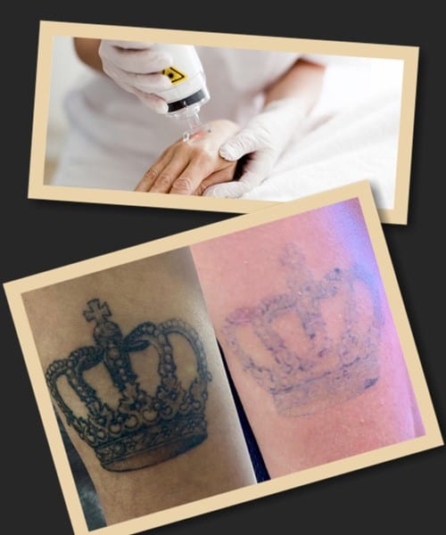 процедура видалення татуювання