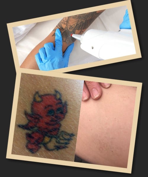 повністю вивести татуювання