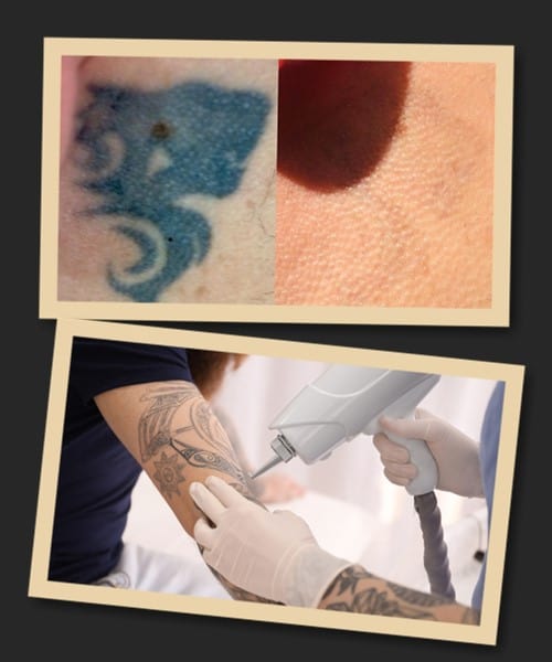 протипоказання у лазерного видалення тату