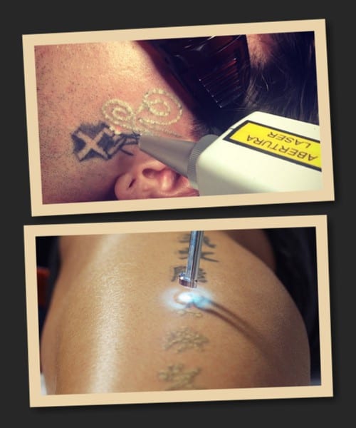 Методи видалення тату