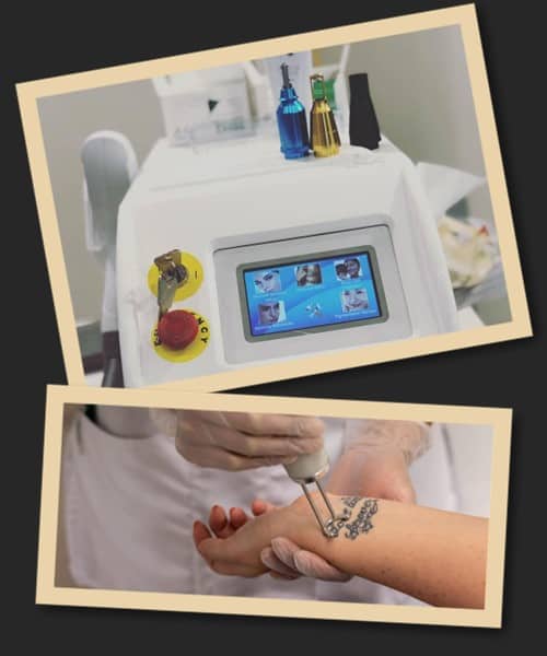 Особливості процедури лазерного видалення татуювань