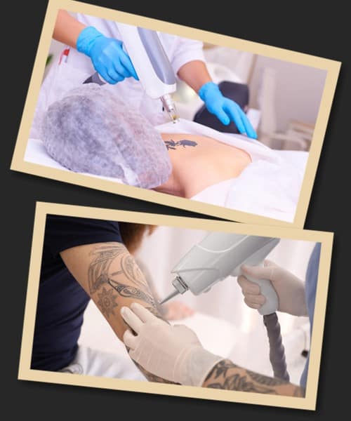 Видалення татуювань ціни