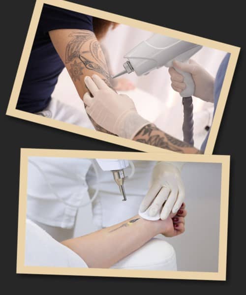 Як відбувається виведення татуювань?