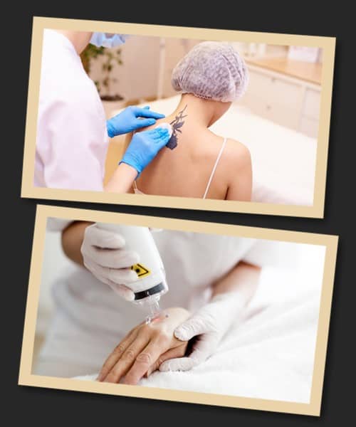 Скільки коштує видалити татуювання?