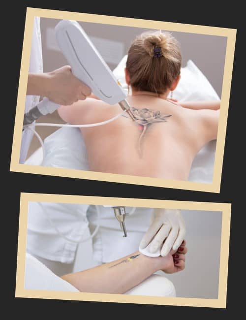 Вивести татуювання у Києві