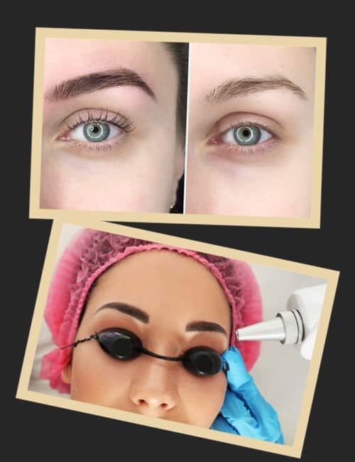 Видалення татуажу ремувером або лазером