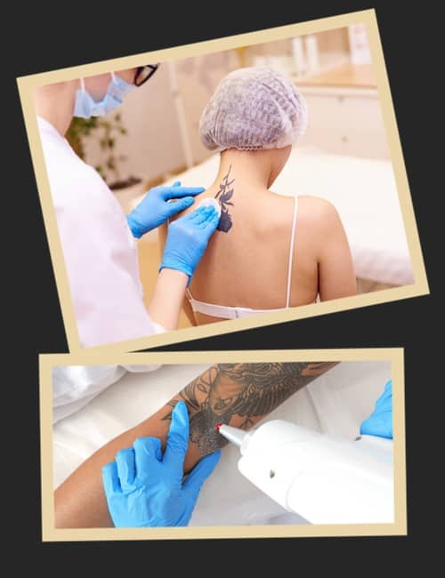 Видалення татуювання лазером