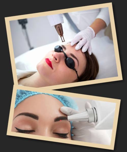 Видалення татуажу брів лазером ціна