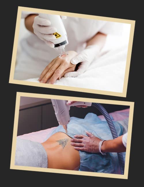 Видалення татуювань лазером ціна