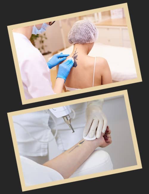 Скільки коштує звести татуювання лазером