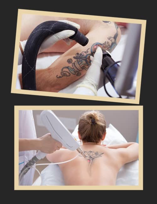 Скільки коштує вивести татуювання в Україні