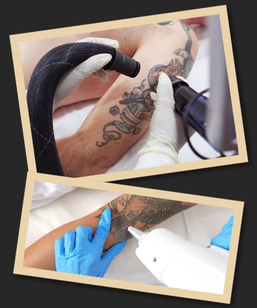 Як позбутися татуювання