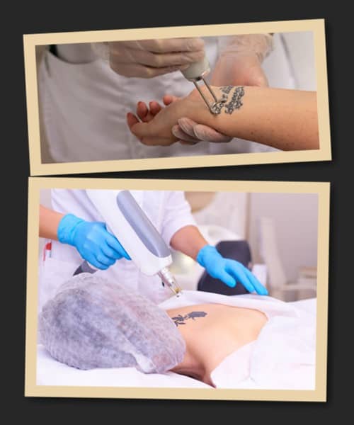 Як видалити татуювання?