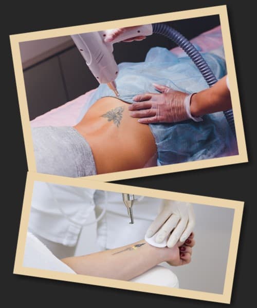 Чи залишаються шрами після видалення татуювань