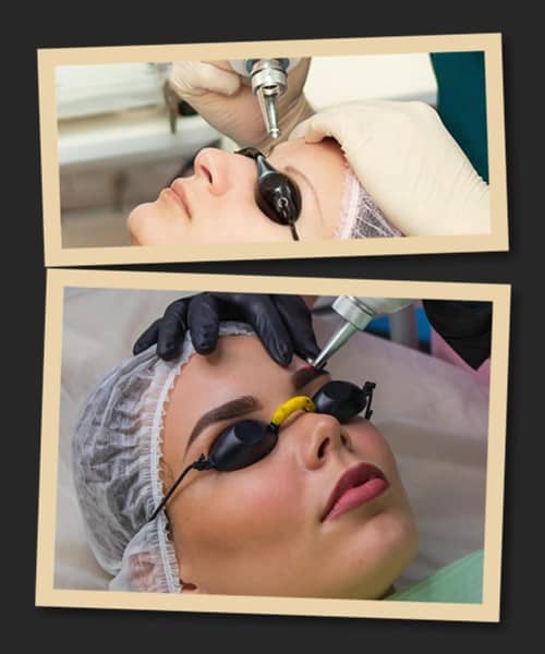 Лазерне видалення татуажу брів ціна