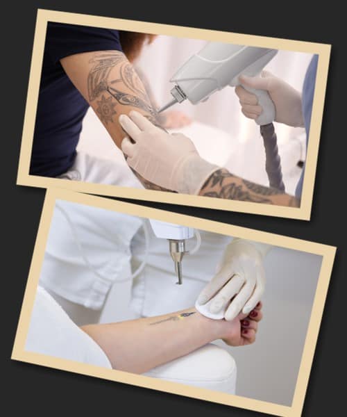 Як відбувається зведення татуювань