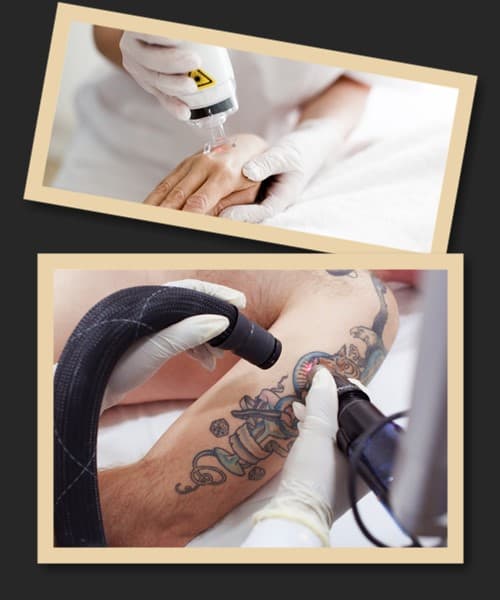 Скільки коштує прибрати тату