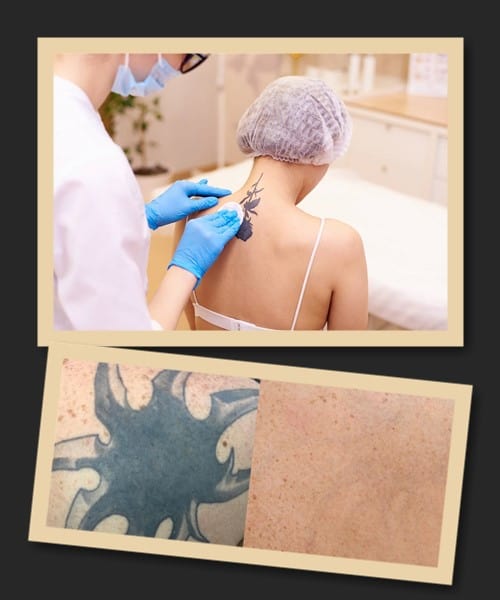 Як можна прибрати татуювання