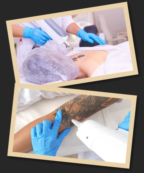 Виведення тату