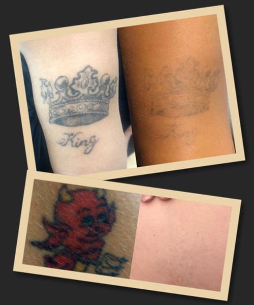 Видалення татуювань ремувером