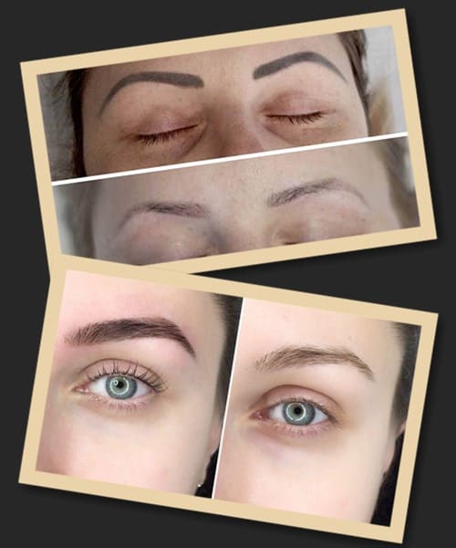 Видалення татуажу ремувером