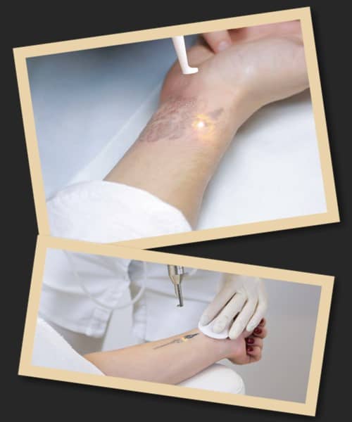 За скільки сеансів видаляють татуювання лазером