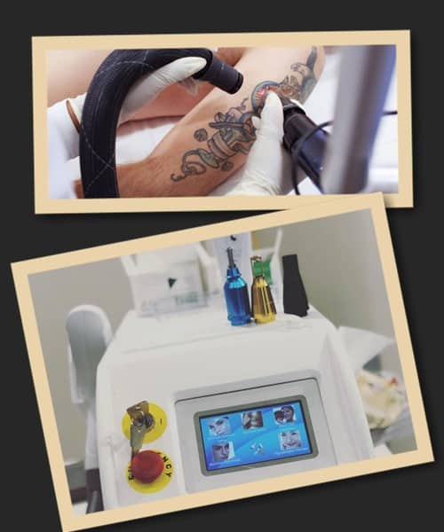 Видалення татуювань неодимовим лазером