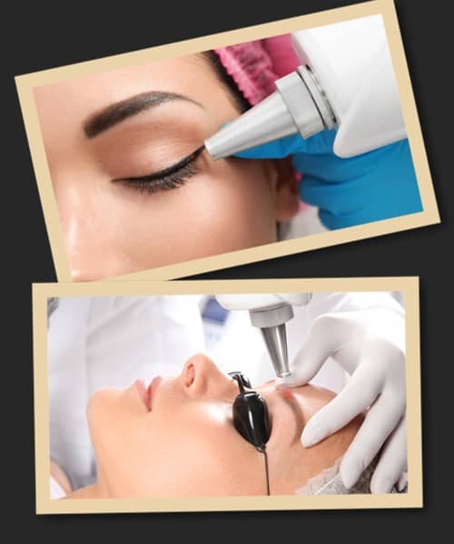 Видалення татуажу очей