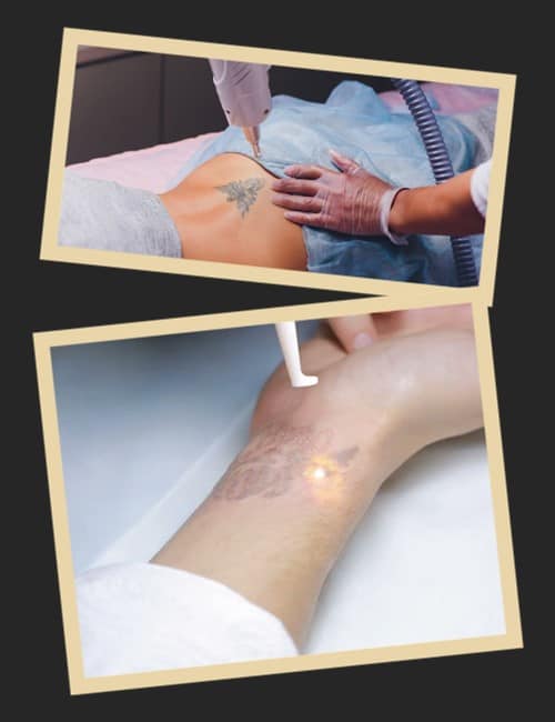 Способи видалення татуювання