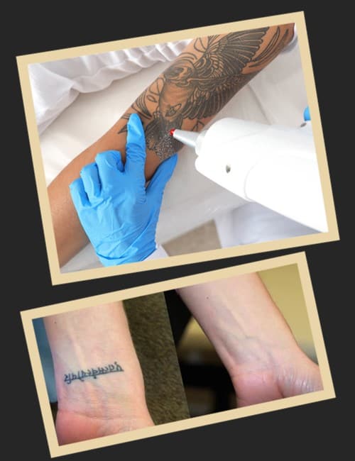 Особливості лазерного видалення тату